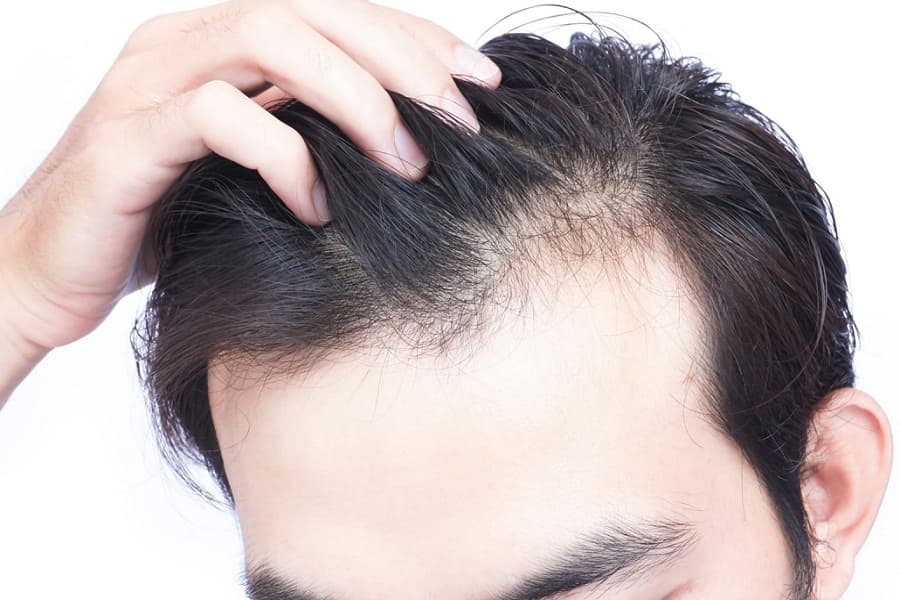 Is pattern-baldness reversible?
