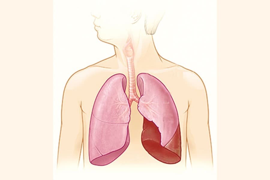 Need for creating greater awareness about pneumonia
