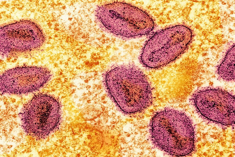 Philippines says two new mpox cases are milder variant