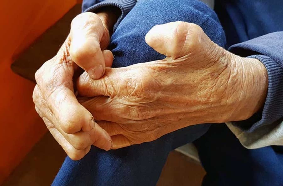 The reemerging problem of Leprosy in Bangladesh
