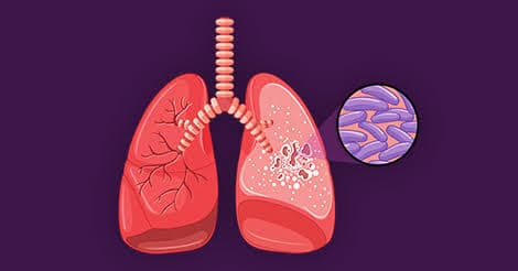 Fight against TB falters amid funding crisis
