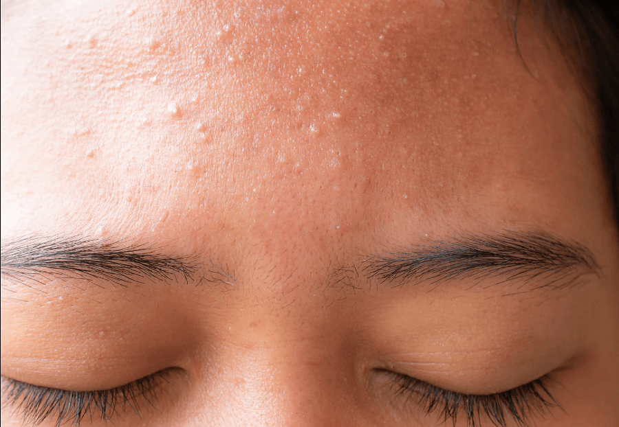 Common skin bumps and their treatment