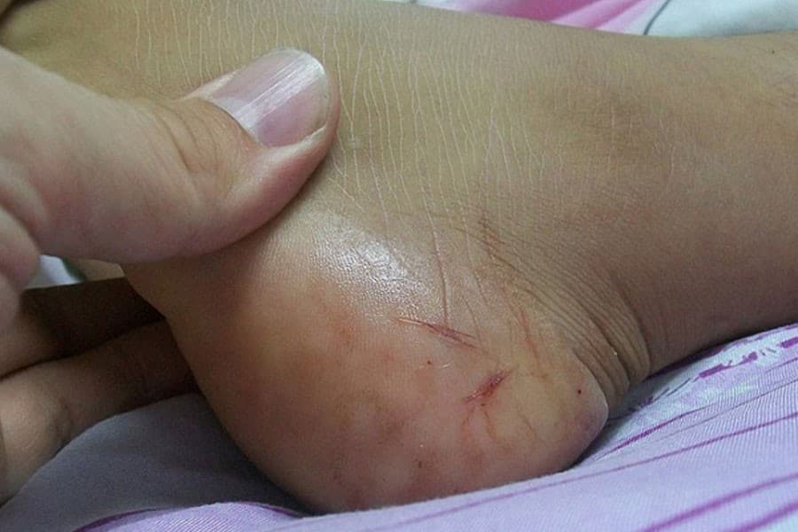 Snakebite now a severe threat to public health