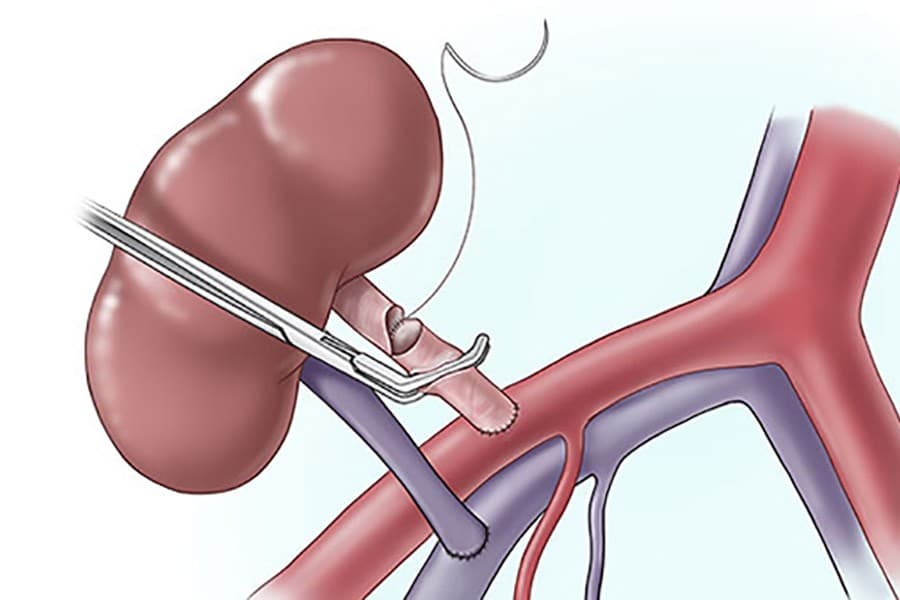 Bangladesh awaits donors for first-ever kidney transplant from brain-dead