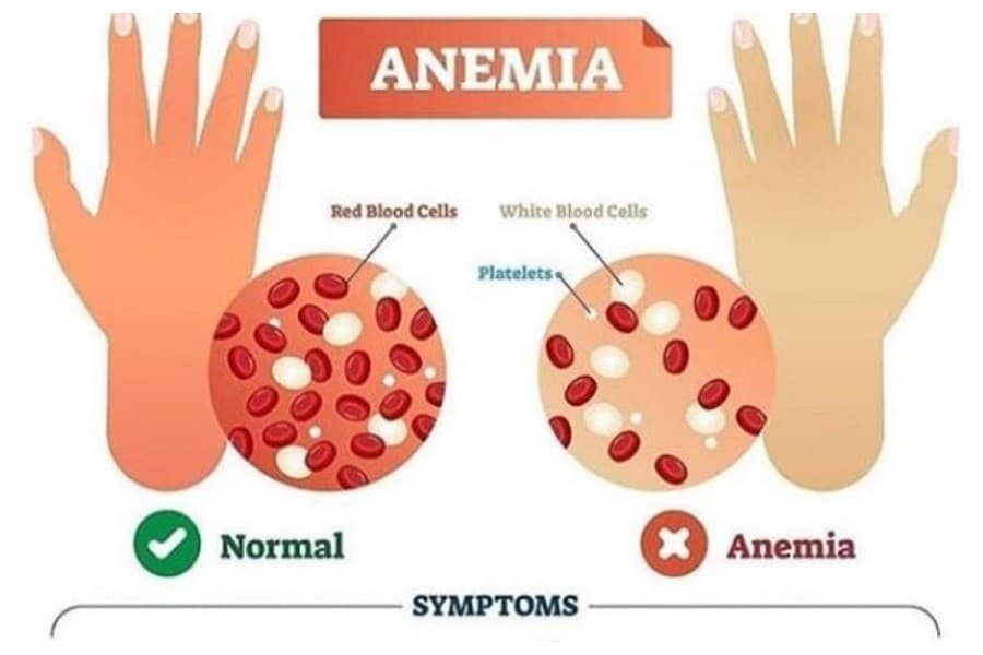 Health impact of anaemia and how to deal with it