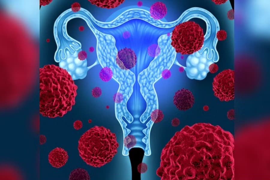 India develops its first cervical cancer vaccine