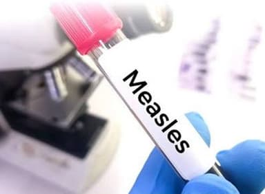 Three children die with measles symptoms in Sylhet