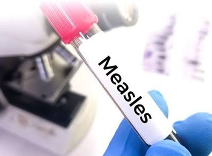 Three children die with measles symptoms in Sylhet, toll rises to 103