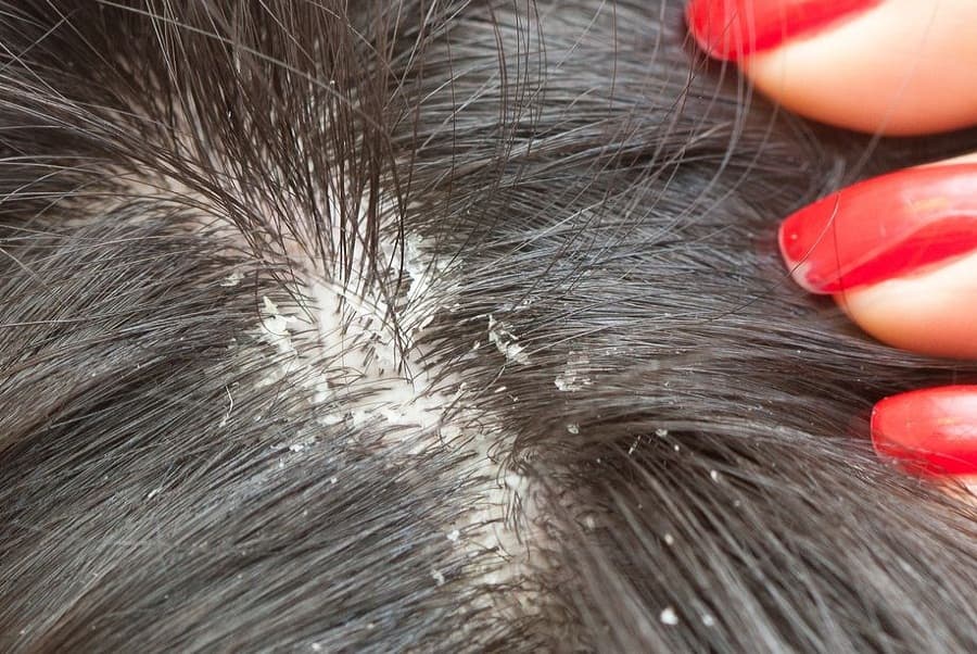 Dealing with dandruff in winter