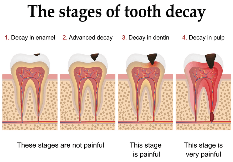 What causes tooth decay?